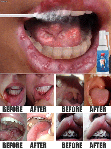 Ning fogászat Li Ke Stop Spray Fogászat