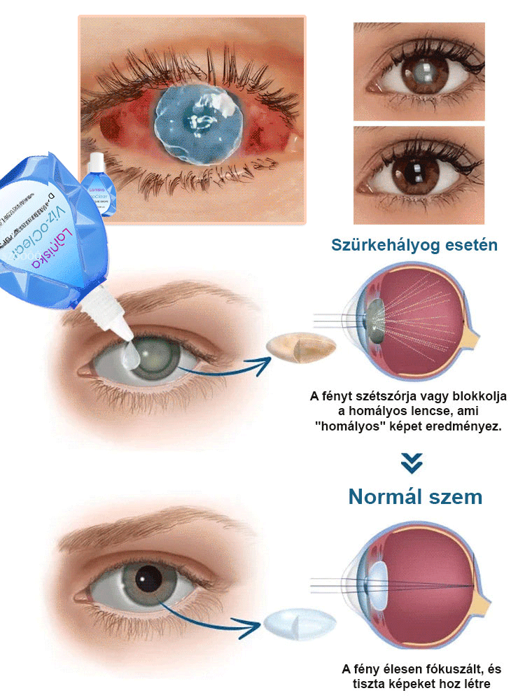 Látásjavító Szemcsepp-Nincs szükség műtétre a látás helyreállításához!