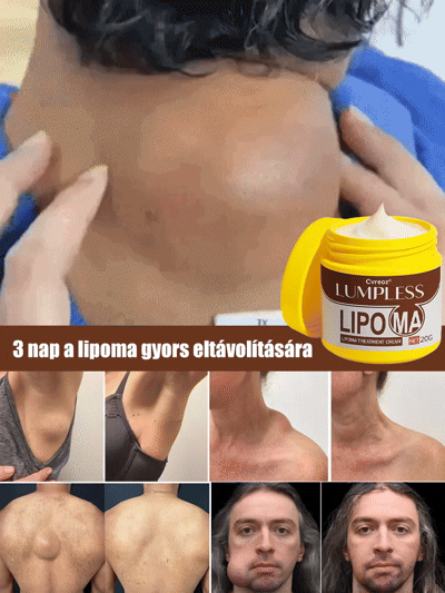 【Egy kenet és nem újul ki】Hét nap alatt eltünteti a lipómákat kenőcs
