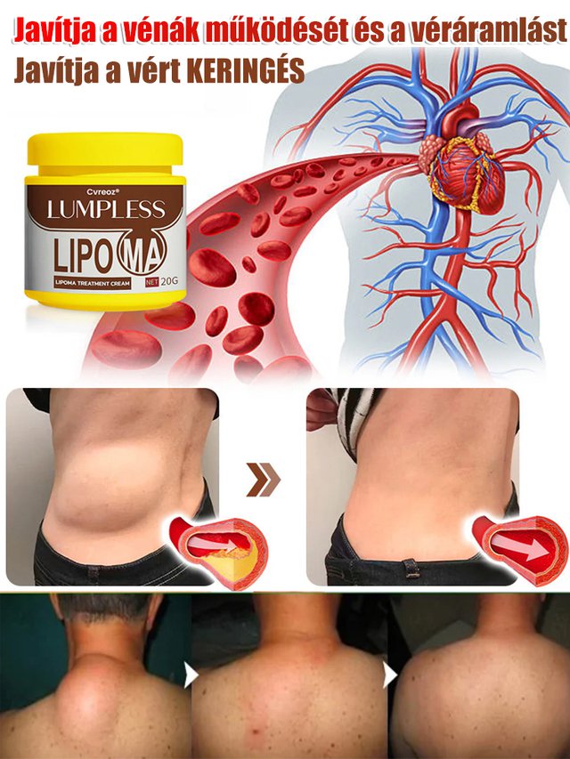 【Egy kenet és nem újul ki】Hét nap alatt eltünteti a lipómákat kenőcs