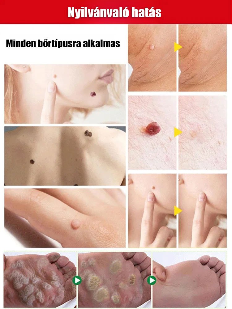 【A szemölcs eltávolítása nem ismétlődik】 Yi Baisui You Monkey antibakteriális folyadék