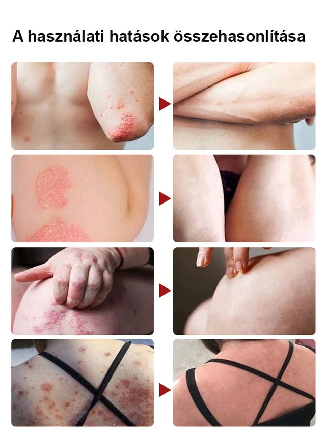 Miaojiang százfű viszketésgátló és antibakteriális kenőcs